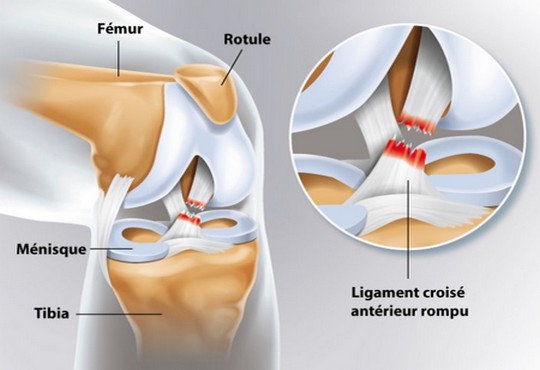 Ligament croisé : rupture, chirurgie et rééducation