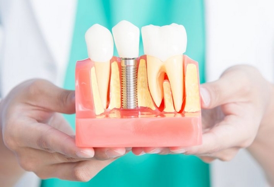 Que savez-vous sur les implants dentaires ?