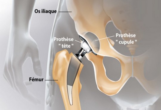 Ce qu’il faut savoir sur la chirurgie de la prothèse de la hanche