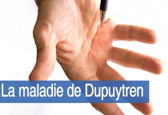 Chirurgie de la maladie de Dupuytren