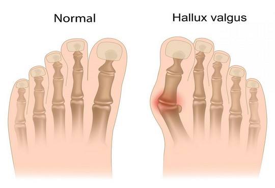 Hallux valgus : tout savoir sur la pathologie et la chirurgie