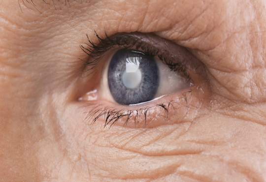 Le glaucome : la maladie oculaire la plus répandue dans le monde