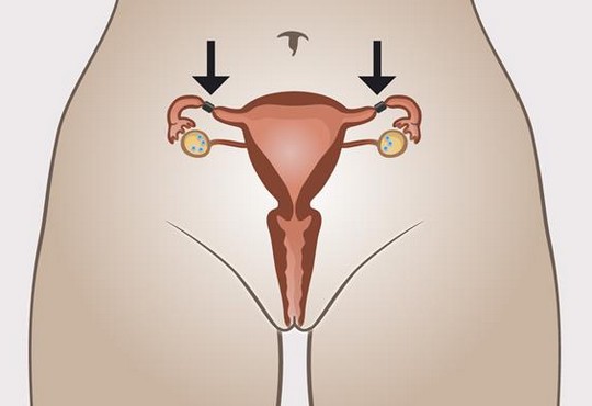 التعقيم الأنبوبي للمرأة :  ماهو وكيف يتم ؟