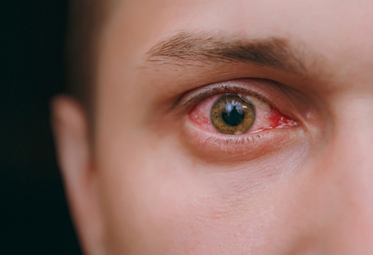 عيون حمراء ...عليك بمراجعة طبيب العيون قد تكون التهاب الملتحمة 